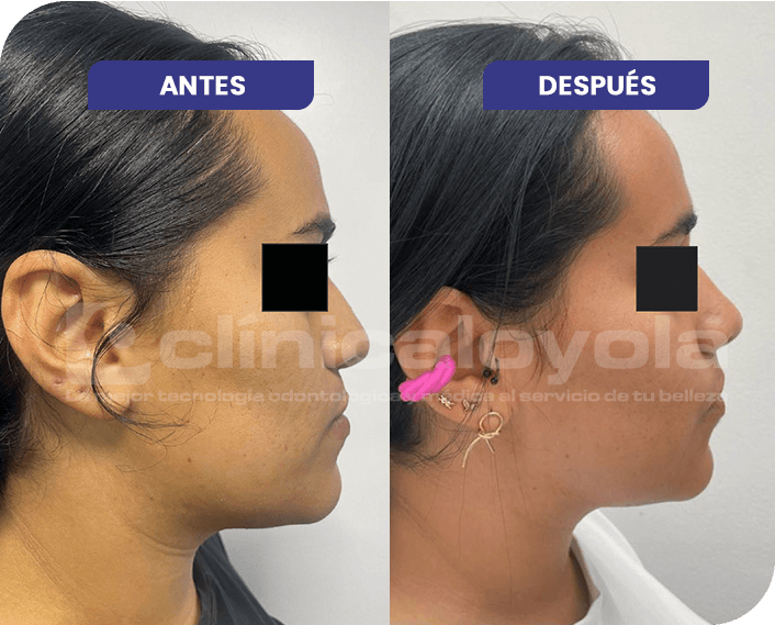 2024_Oct_CasoExito_7_Cirugia_Ortognatica_Maxilar