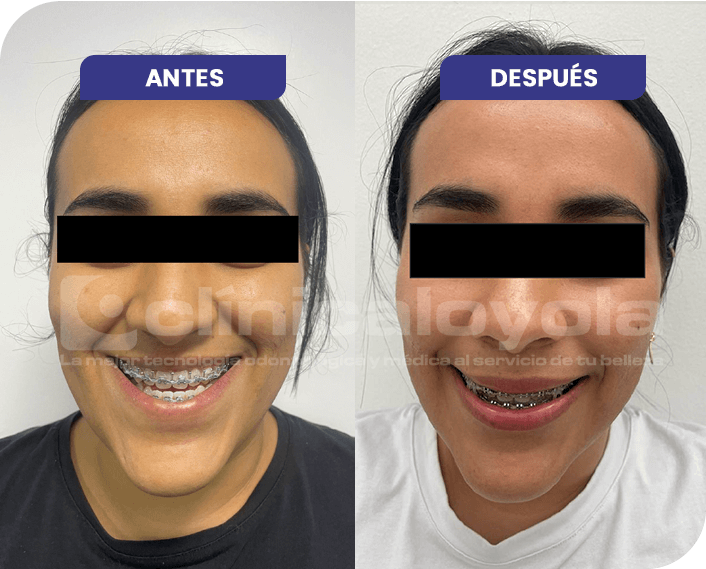 2024_Oct_CasoExito_7_Cirugia_Ortognatica_Maxilar2