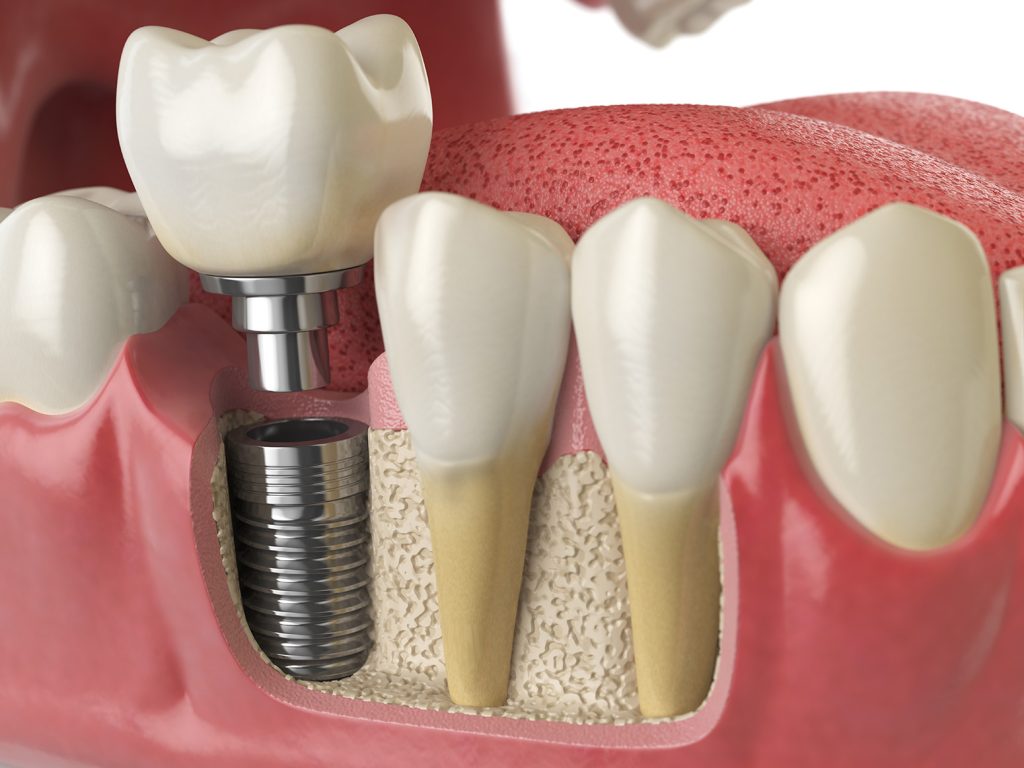 tipos de hueso para implantes dentales